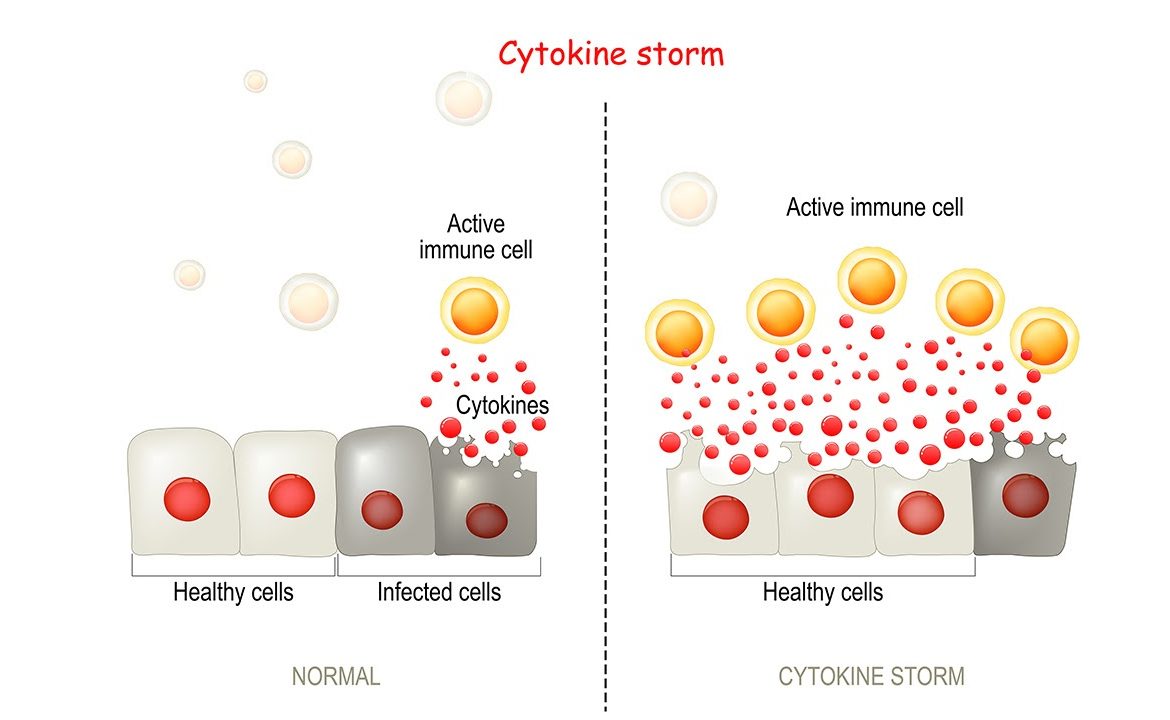 All You Need to Know about the COVID-19 Cytokine Storm