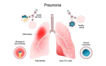 Pneumonia Transmission and its Risk Factors
